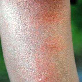 mosquito bite on leg closeup detail