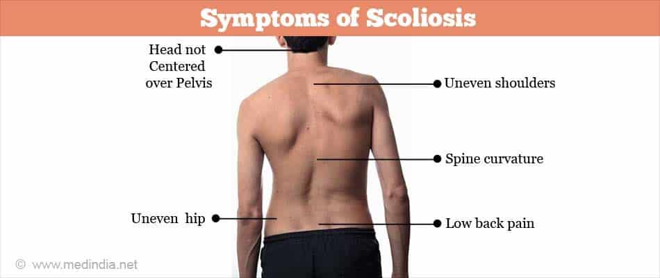 SYMPTOMS OF SCOLIOSIS