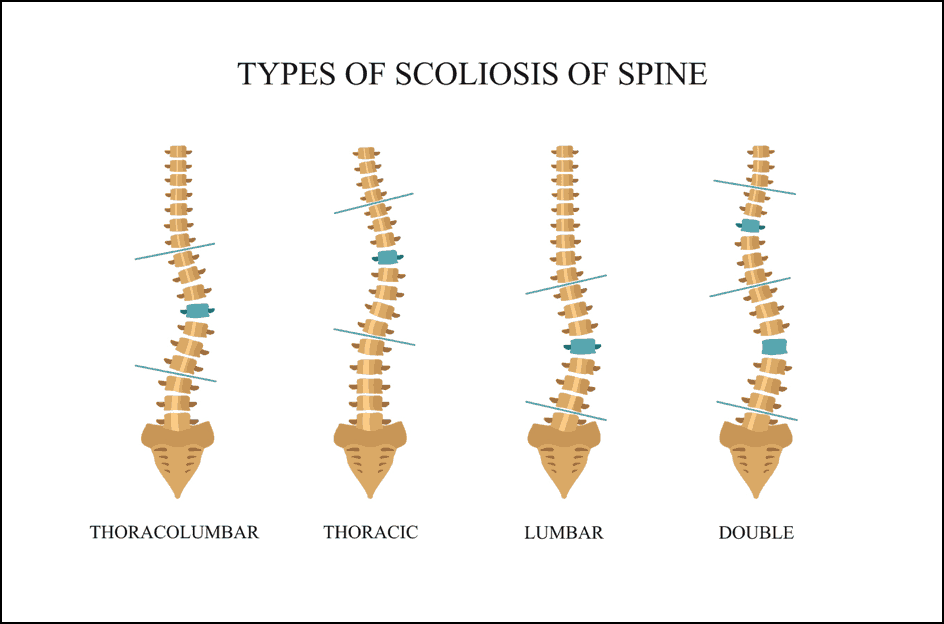 types of Scoliosis pain