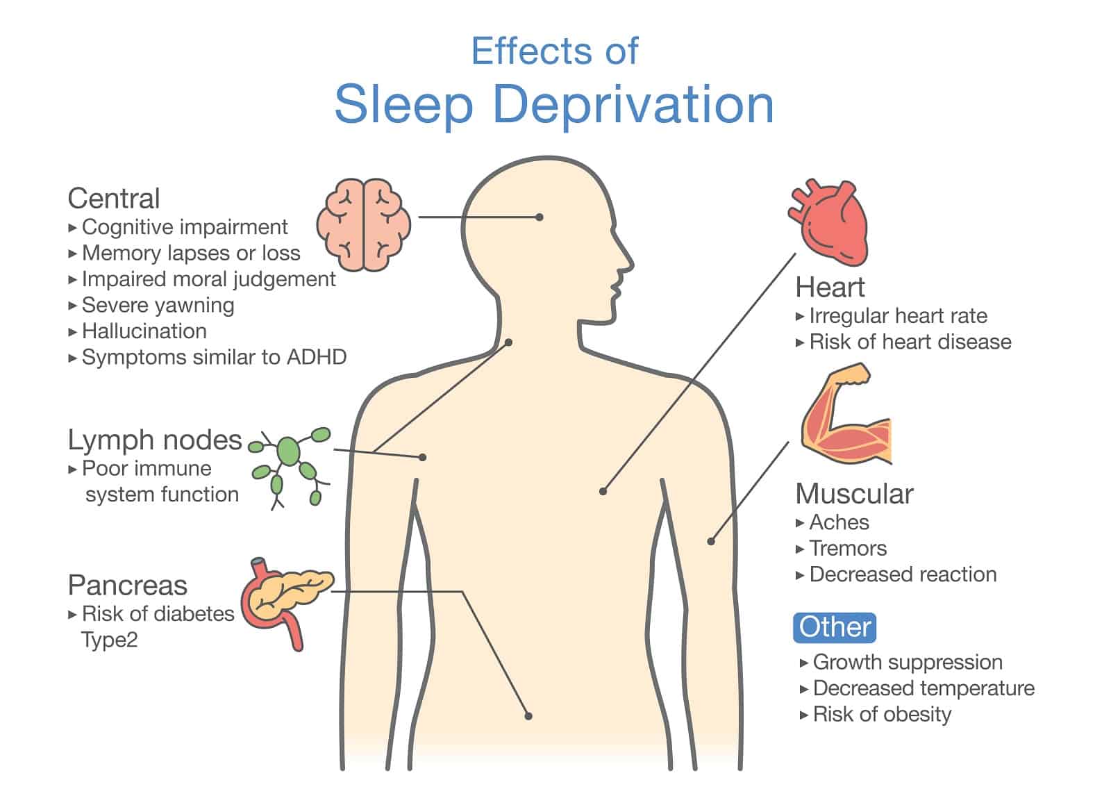 Diagram of Effects of Sleep deprivation1