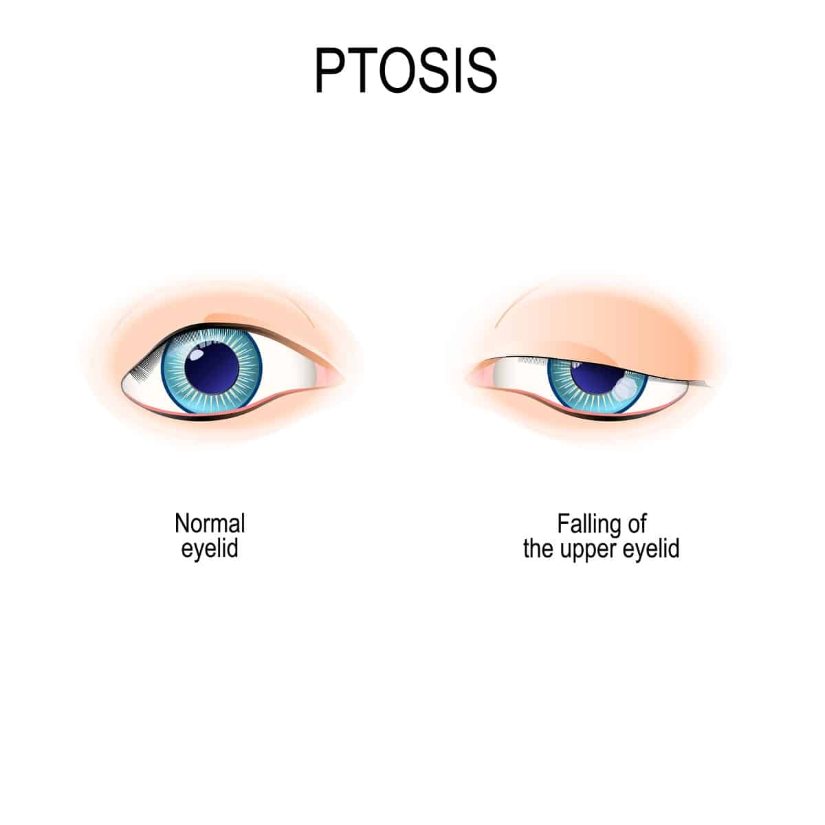 Ptosis is a drooping of the upper eyelid